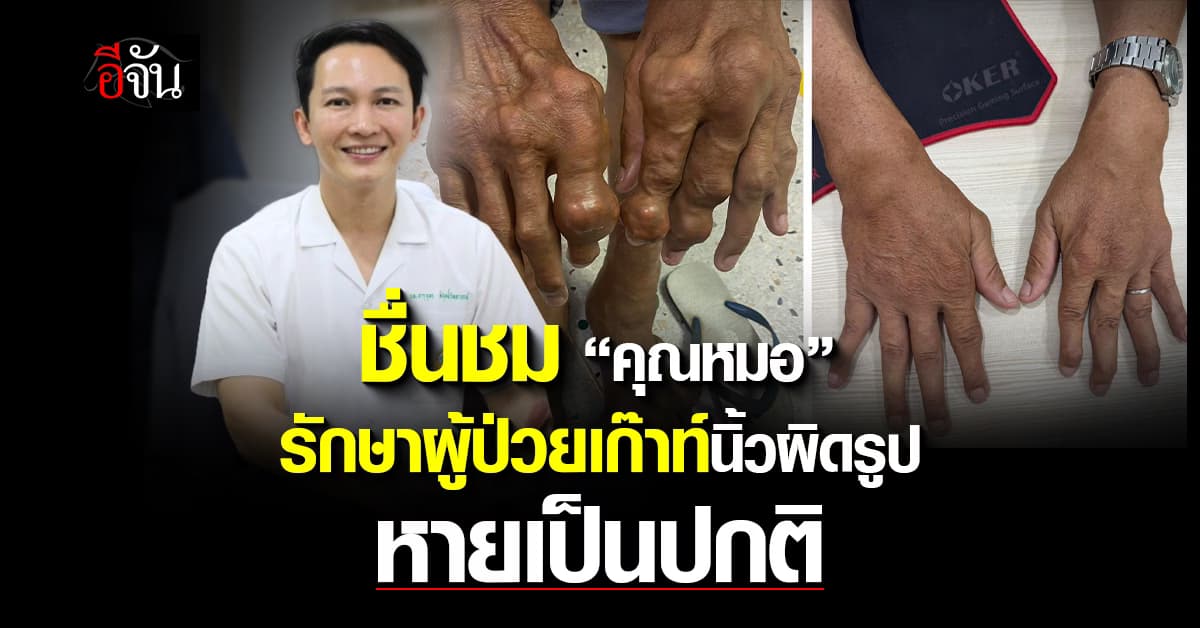 ชื่นชม “หมอโรคไต” รักษาผู้ป่วยเก๊าท์นิ้วผิดรูป หายเป็นปลิดทิ้ง