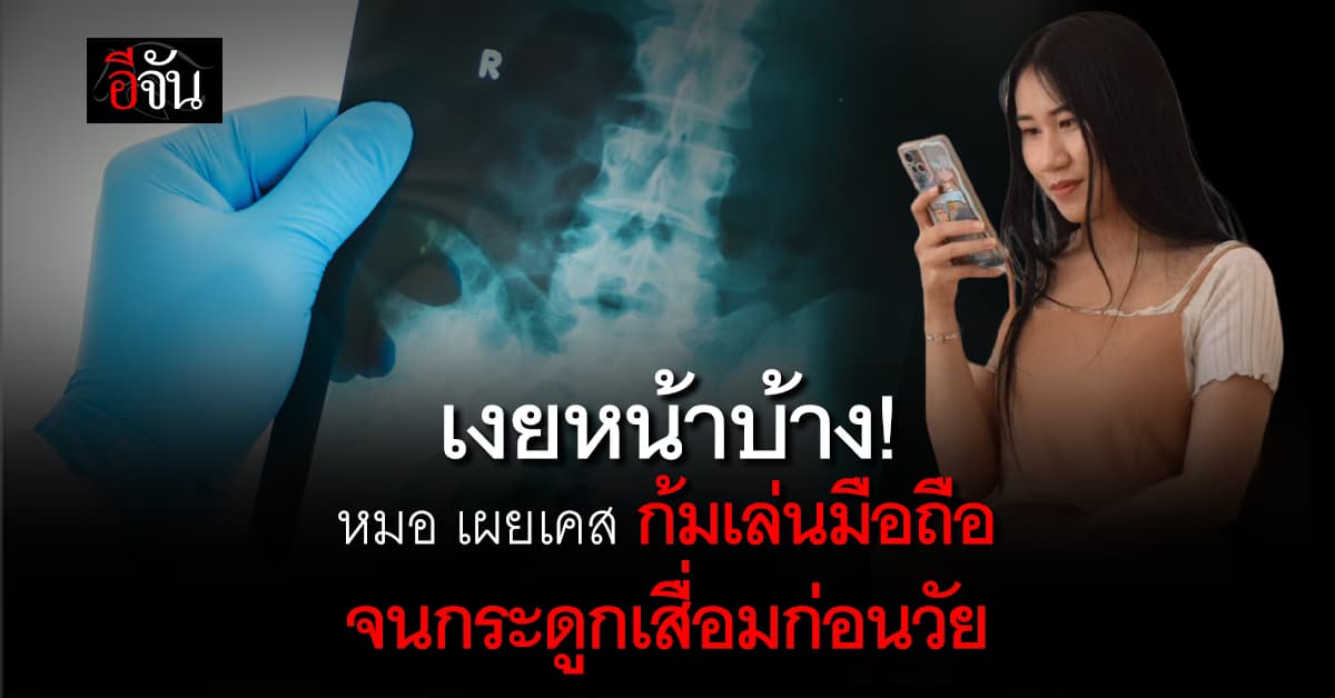 อย่าก้มนาน! หมอเผยเคส สาว วัย 35 ปี ก้มเล่นมือถือ จนกระดูกเสื่อมก่อนวัย