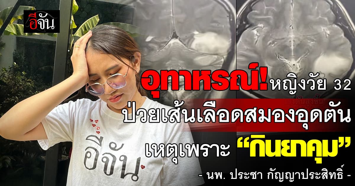 อุทาหรณ์! หญิงวัย 32 กินยาคุม-ปวดหัวหนัก สุดท้ายพบ “เส้นเลือดสมองอุดตัน”