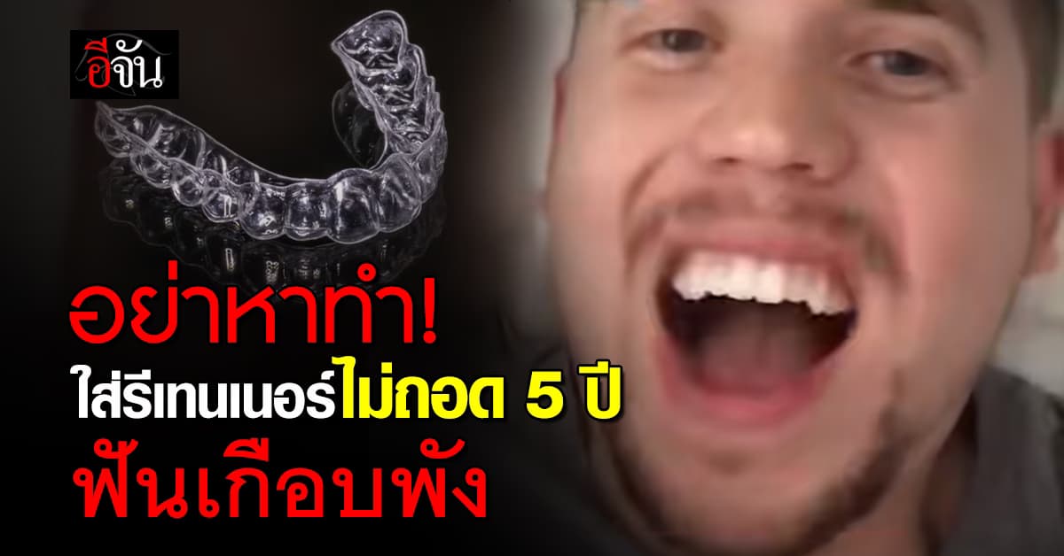 อุทาหรณ์! ชายใส่รีเทนเนอร์ไม่ถอดนาน 5 ปี ทำฟันเกือบพัง