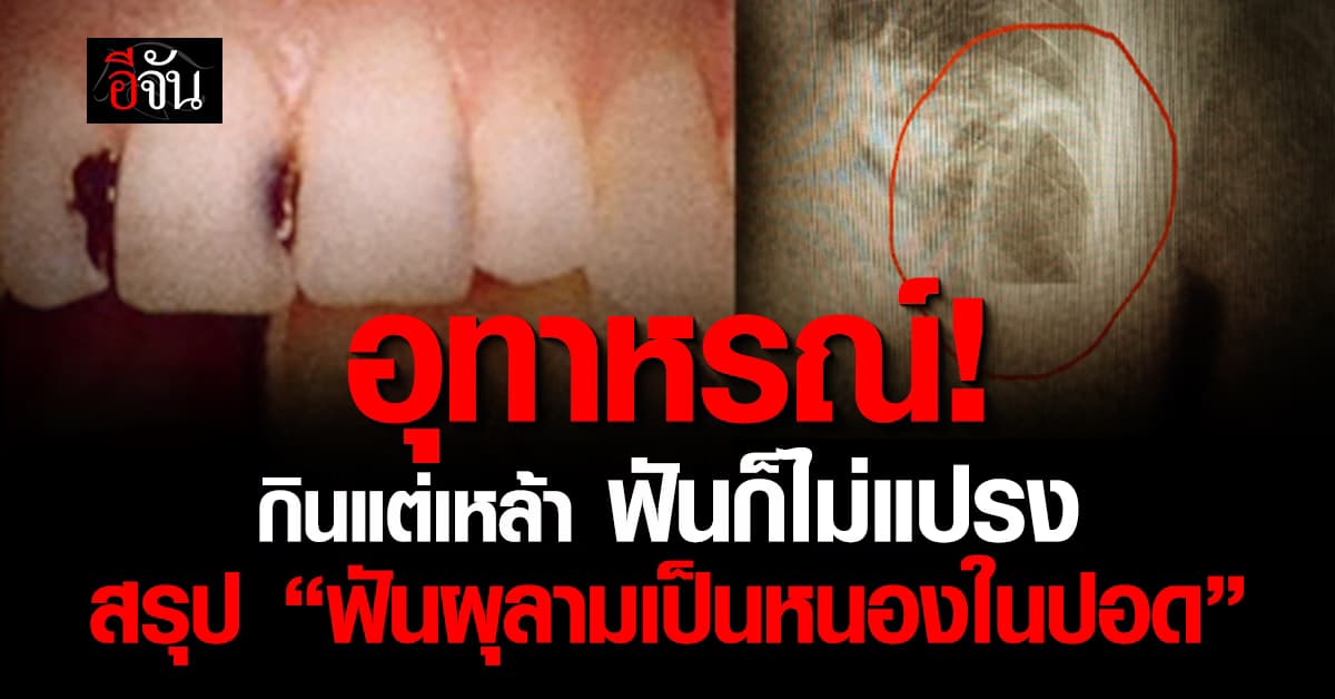 ภาพนี้มีกลิ่น! ชายไทย “กินเหล้า ไม่แปรงฟัน” สรุป ฟันผุลามเป็นหนองในปอด
