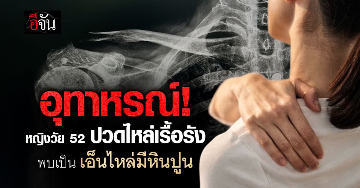 เช็กให้ดี! ปวดไหล่เรื้อรัง-ยกแขนไม่ขึ้น เป็นสัญญาณเตือน “เอ็นไหล่มีหินปูน”