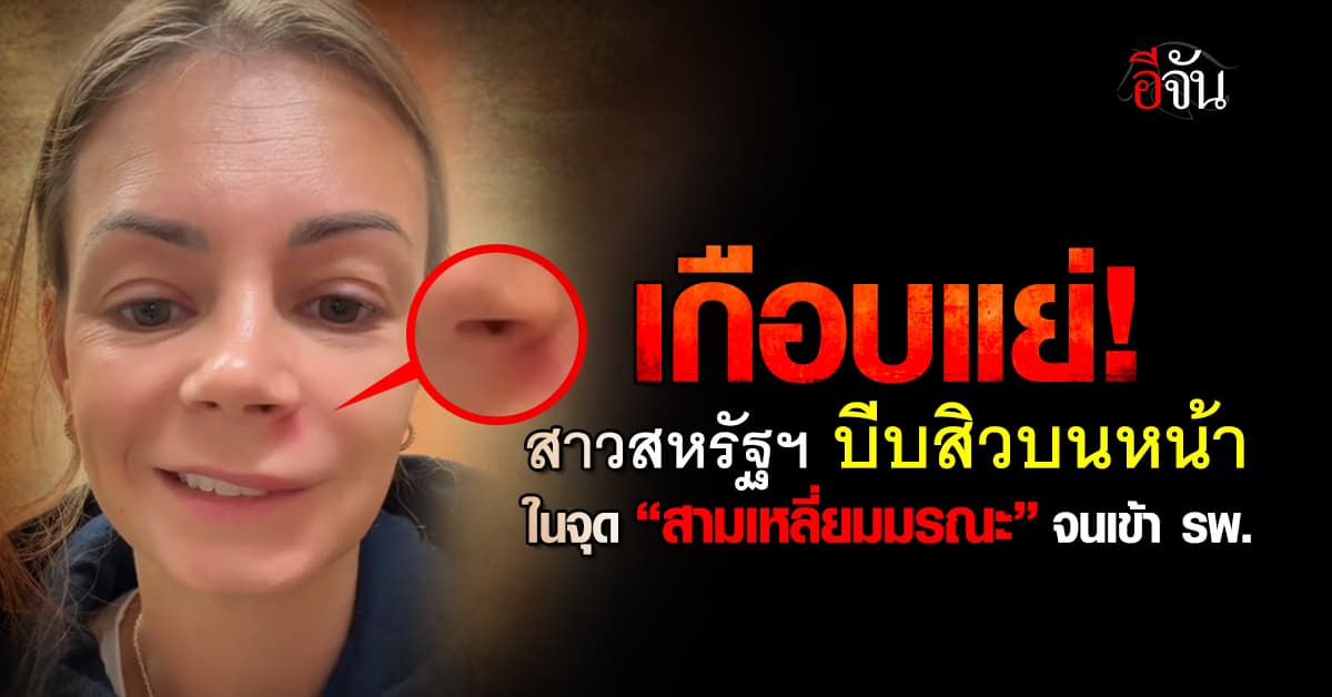 สาวสหรัฐฯ แชร์อุทาหรณ์! บีบสิวบนหน้าผิดจุด ทำชีวิตเกือบแย่