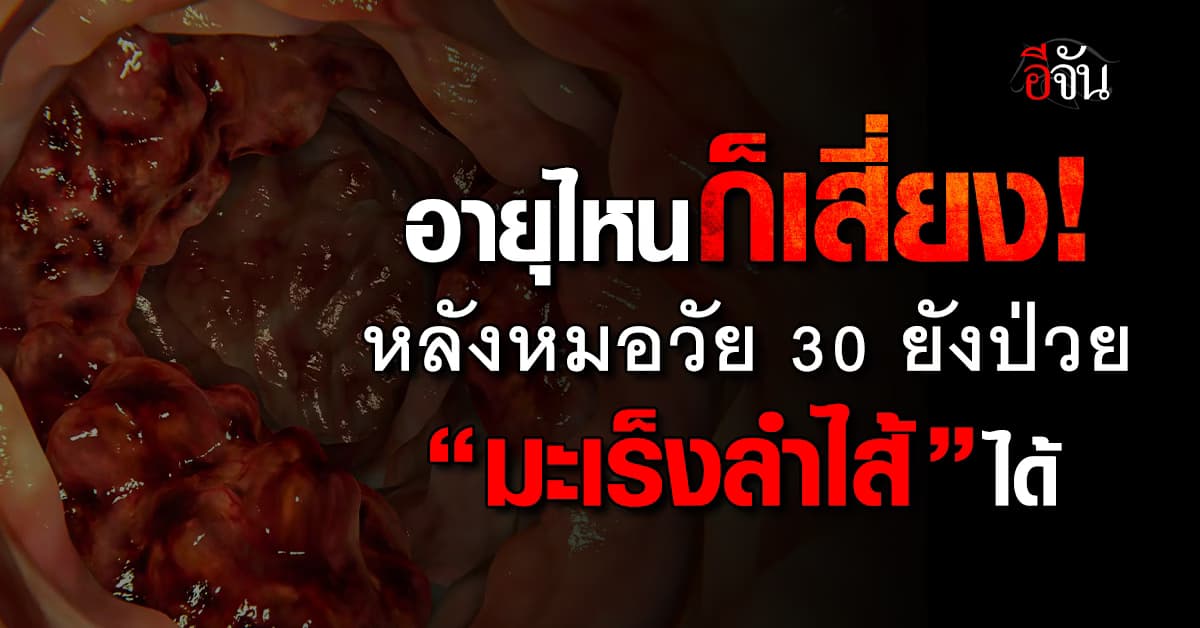 หมอ ยกเคสเตือน หลังคนวัย 30 ป่วย “มะเร็งลำไส้” ย้ำ โรคไม่เลือกอายุ