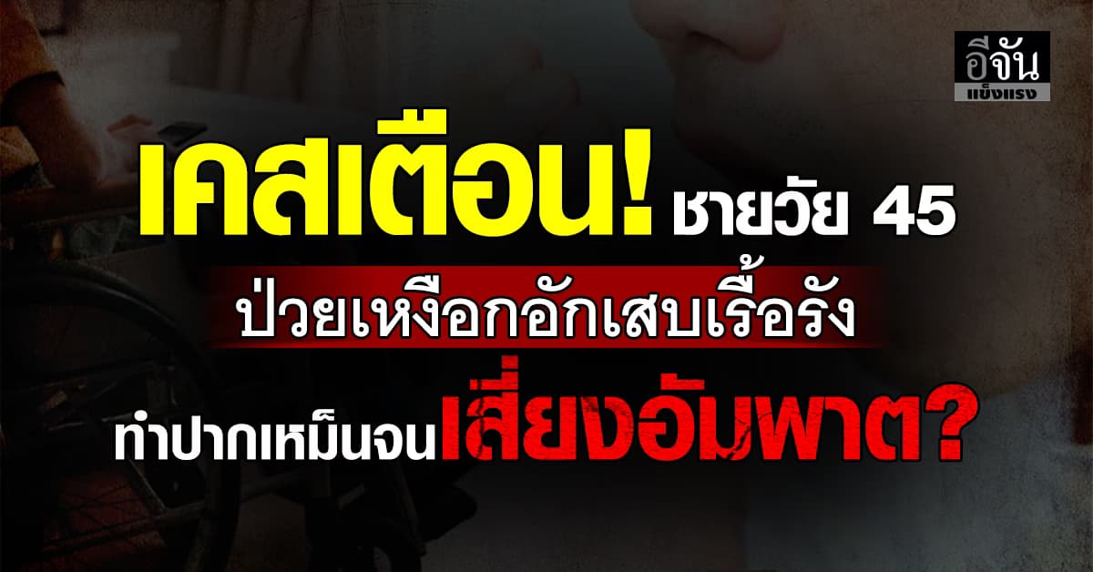 ภัยเงียบมั้ย? หมอ ยกเคส ชายวัย 45 ป่วยโรคเหงือกอักเสบเรื้อรัง จนเสี่ยงอัมพาต?