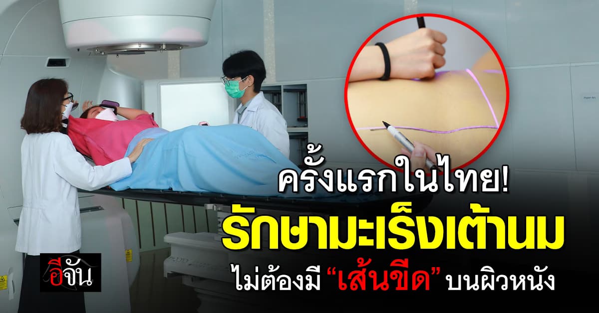 ครั้งแรกในไทย! รพ.จุฬาฯ ใช้ SGRT ฉายแสงมะเร็งเต้านม ไม่ต้องขีดเส้นบนผิวหนัง